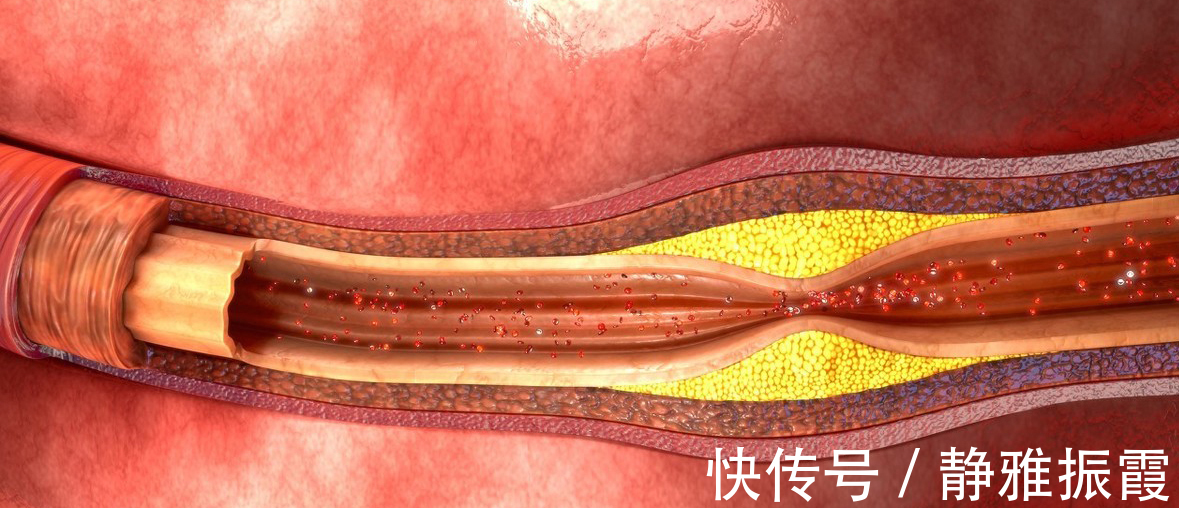 心血管堵塞|低密度脂蛋白升高意味着什么,容易心肌梗死和脑梗塞,怎样降低它