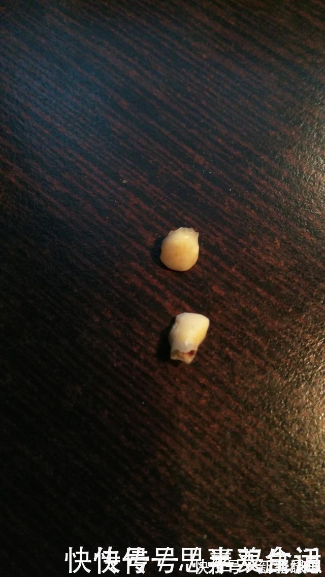 六龄齿|送给孩子正在换牙的父母们,你们一直都做错了什么?