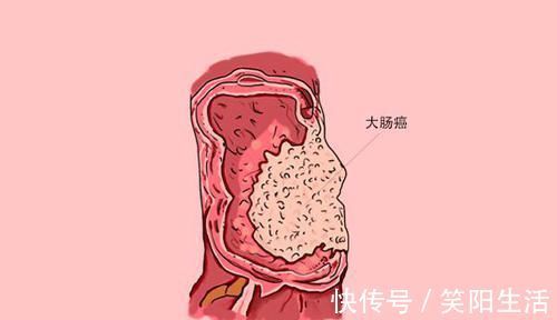 切除|哪些癌症及时发现及时治疗，治愈率高早点了解，别轻易放弃
