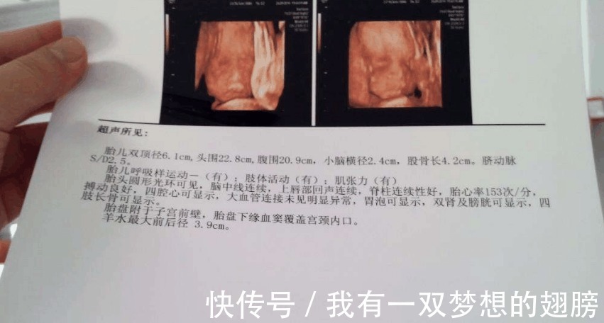 准妈妈|B超单上的这4个字是什么意思 别担心, 别人羡慕还来不及呢!
