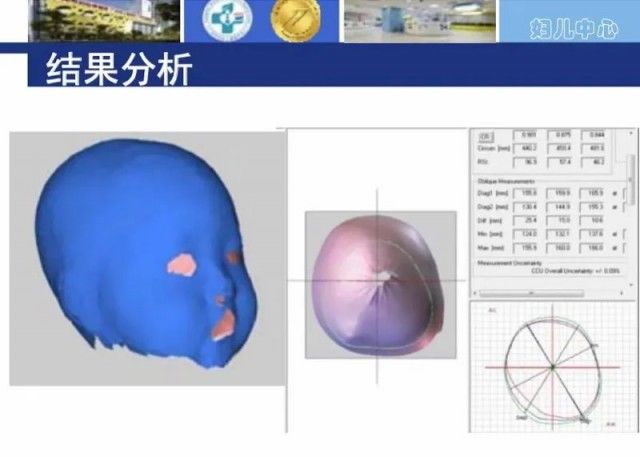 婴儿|“婴儿网红头盔”大火！可有家长发现孩子像“奥特曼”了