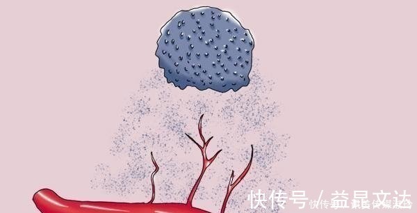 模拟|靠食物能不能消除肿瘤？不吃会不会饿死肿瘤？医生辟谣来了