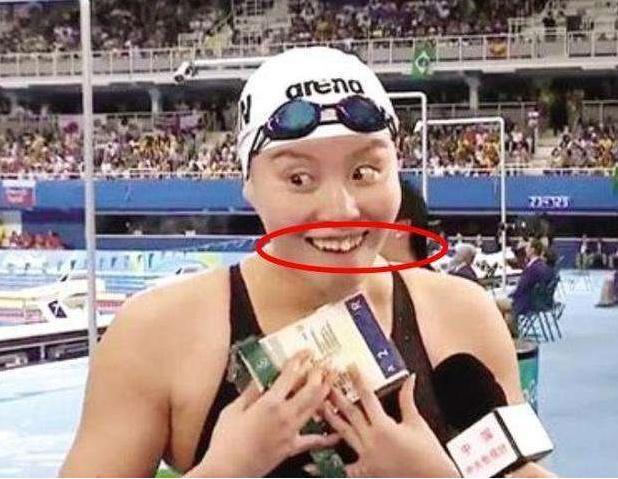 牙齿|有种“整容”叫傅园慧,整牙前后判若两人:被严重低估的颜值
