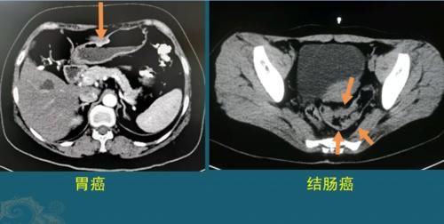  治愈的病|生存期长的癌症有哪些？医生用CT片举例，至少3类