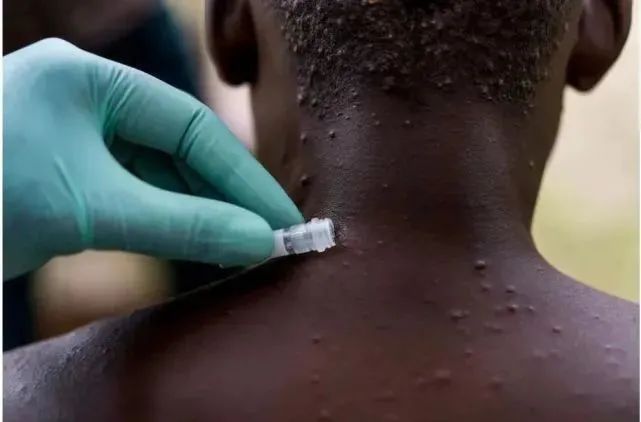 猴痘病毒|类似天花,时隔近20年美国再现这一病毒