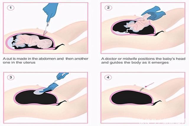 宝妈|顺产和剖腹产该怎么选?各有各的优点,但有几种情况要选择剖腹产