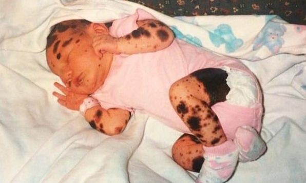 胎记|17岁姑娘满身胎记,从小被人嘲笑,妈妈这是上帝留下的吻痕