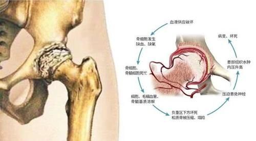 病有帮助|泡温泉对有骨病的人有帮助吗？