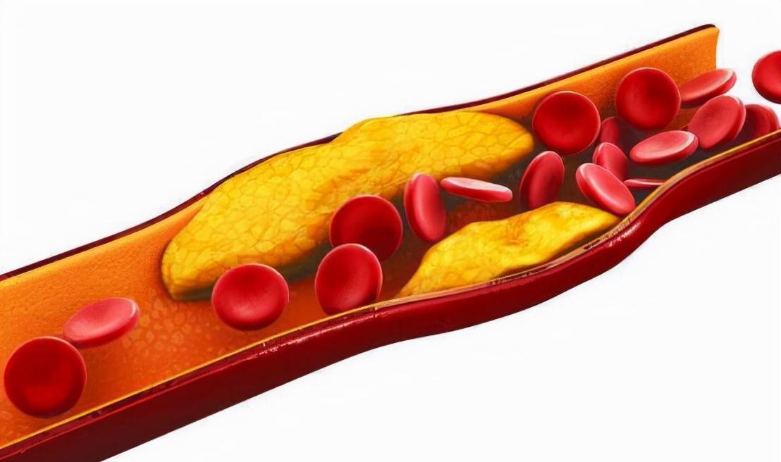 血脂异常|瘦子也会得高血脂？降低血脂遵守“四低一高”原则很重要