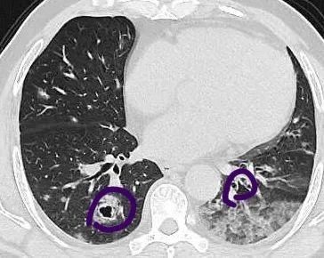肿瘤|大伯肺里刮“台风”？竟然已是癌症晚期