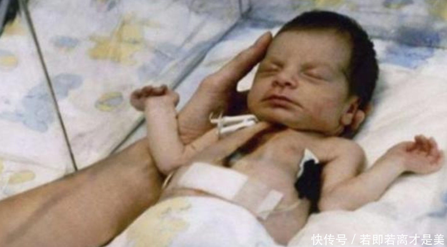 年前|36年前,移植“狒狒”心脏的女婴成功续命,结局却令人惋惜