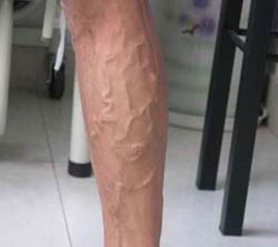手背上有很多青筋鼓起，是不是血管疾病，原因是3个原因导致
