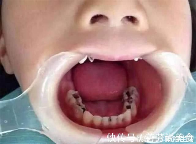 生活质量|5岁男孩的牙齿全部烂掉，医生训斥无知，妈妈没想到这么严重