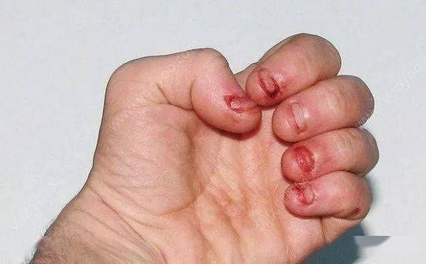 触觉|小孩出现撞头、咬指甲、撕嘴皮等行为，妈妈一定要警惕了