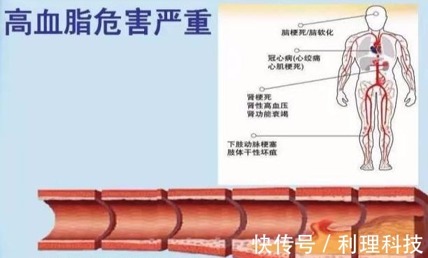 原发性|有7种表现可能血脂高了,医生提醒7项措施做好,保证血管顺畅