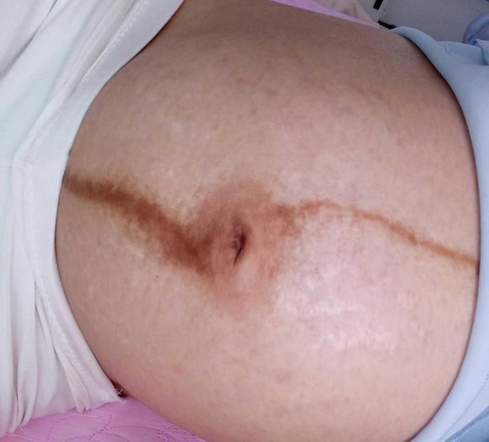 宝宝|怀孕之后肚子上浮现一条“黑线”,妈妈嫌丑婆婆嫌细,别再迷信了