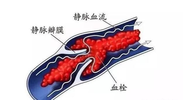 萝卜|清血栓的3种蔬菜，每天吃一种，清理血液血管不堵