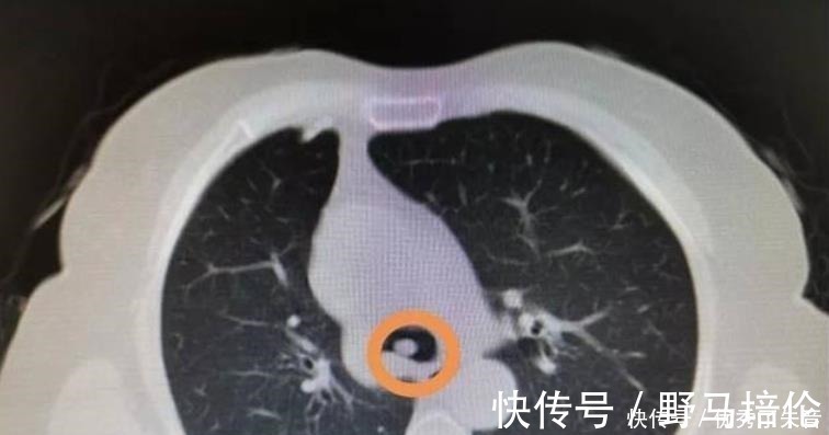 威力|男童气管被“胶”堵住,学校门口的“美味”,威力堪比“寄生虫”