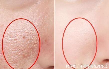 油脂粒 抿紧下巴后突起的“白疙瘩”,千万要注意,这是螨虫的真身吗!