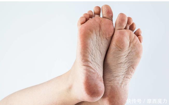 皮肤干燥|脚后跟干裂怎么也治不好找对病因才见效,2个因素你属于哪种