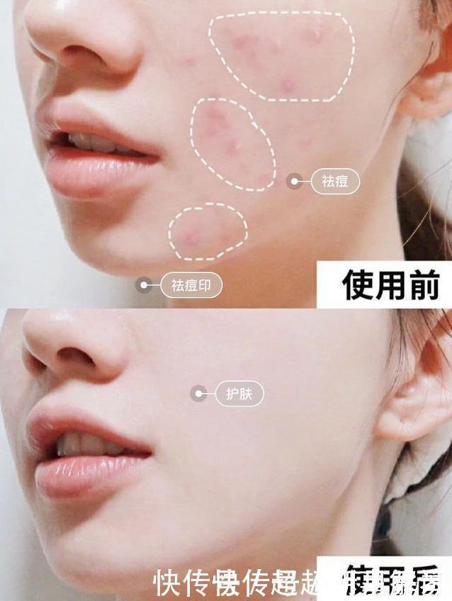 爱长闭口粉刺的女生,每天坚持做这件事,
