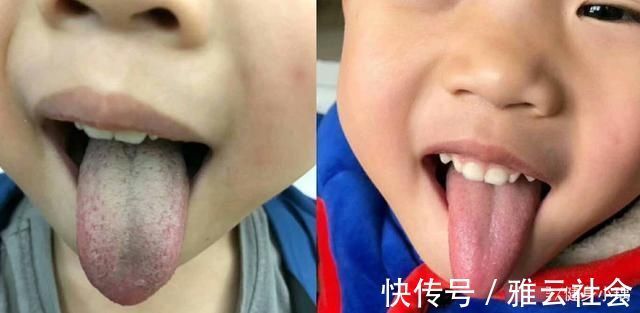 强脾|孩子出现3个异常,多半是被积食缠住了,医生:1招强脾清积食