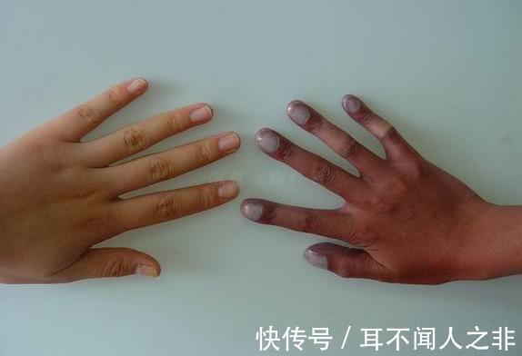 癌变|肺部发生癌变，手上三处“感觉”比较强烈，若全没有肺还很健康