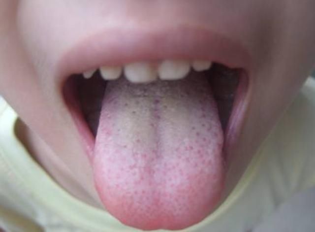 积食|双胞胎长期积食不在意,拖成“疳积”,儿科医生:家长无知造成的