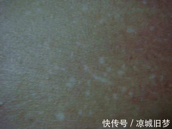 治疗|结节性硬化对生活有哪些影响，可以治疗吗？