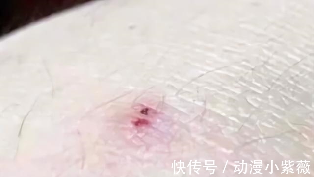 喵娘|日本小哥沉迷日漫《工作细胞》不可自拔,于是他将伤口二次元化了