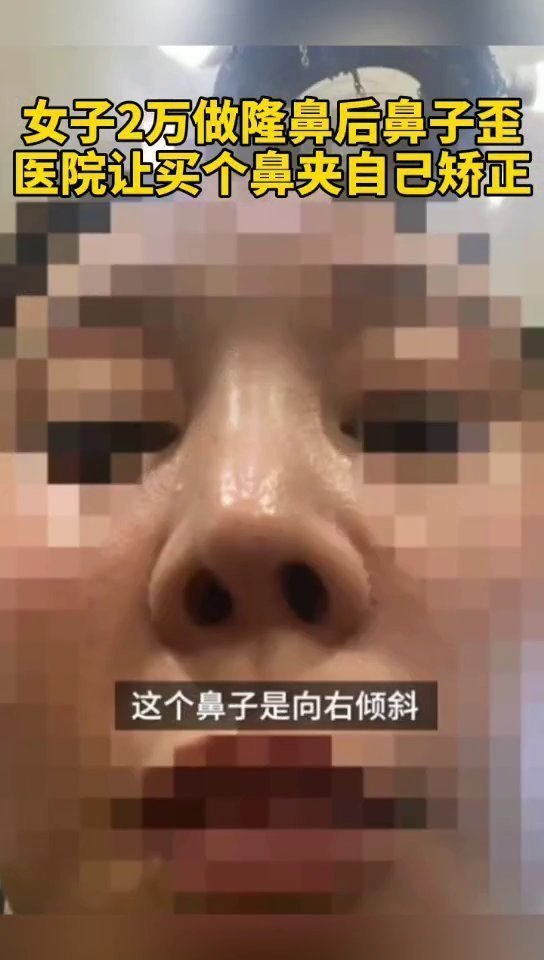陆军总医院|女子花2万隆鼻后鼻子歪了,医院让买个鼻夹自己矫正