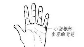 积滞|手上有一条青筋,没事刮一刮,可有效防治脑血栓!身体越来越棒!