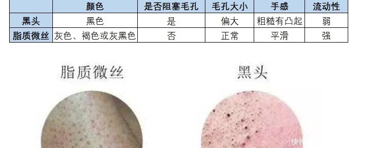 鼻子不干净都是黑头,医生,不是黑头是脂质微丝