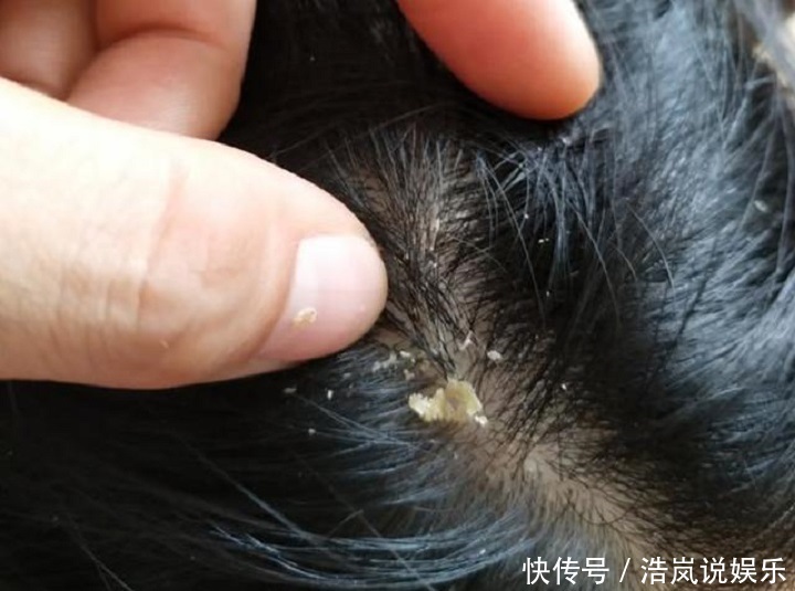 颗粒|头皮上抠下“白色颗粒物”一般逃不过这“3点原因”，别忽视