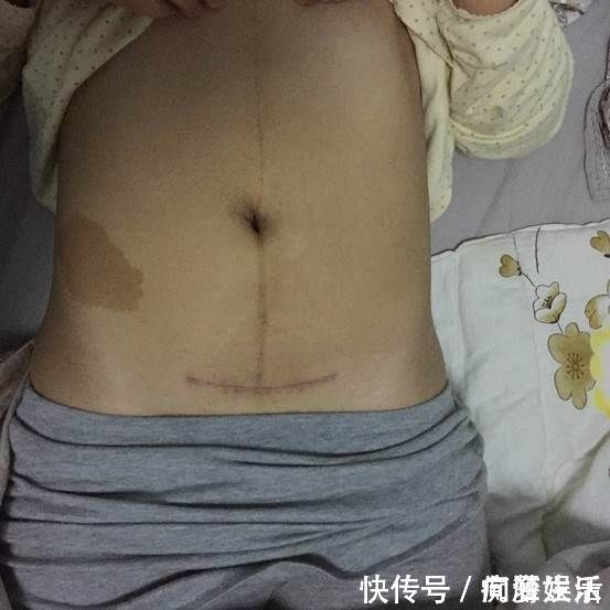 剖腹产|剖腹产的伤口，对女性身体会不会产生伤害，妇产科医生说出真相