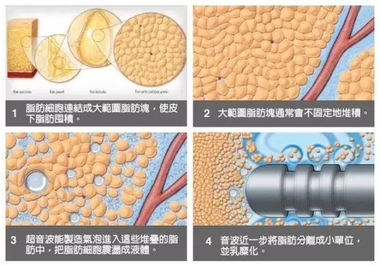 脂肪|吸脂以后没变瘦，还出现了这些吸脂后遗症怎么办？