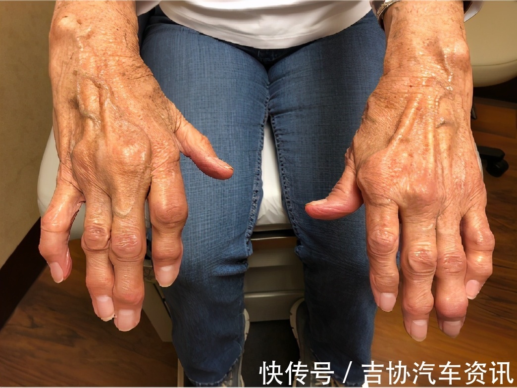 肌肉萎缩|运动神经元肌肉萎缩怎么办?