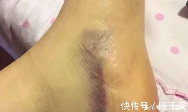 淤青|没磕没碰，为何身上总有淤青？或许与这些原因有关系，别忽视