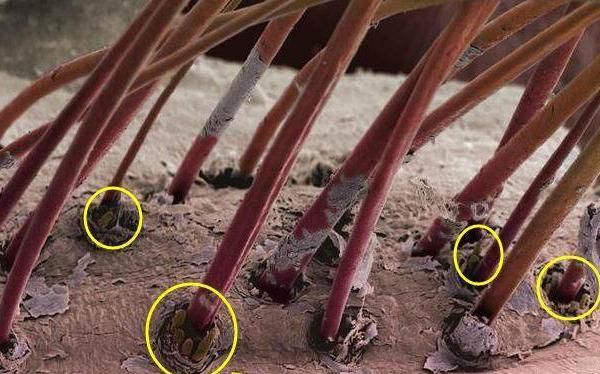 头上有螨虫的人，平时可能会露出4种表现，不要再忽略了