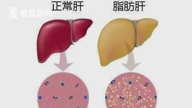 倾向|5岁男孩76斤！腰围跟成人一样粗 已有脂肪肝倾向