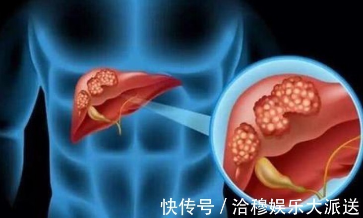 b超检查|肝脏肿瘤早知1年，寿命也许延长10年，肝脏病变的信号，要牢记!