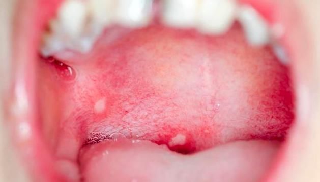 食道管|被发现时已是癌症晚期医生感慨其实身体早就提醒他了