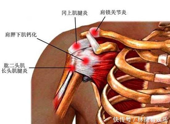 肩膀经常痛 3个动作自测肩周炎 4个拉筋动作告别肩周炎 全网搜