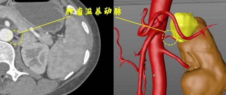 泌尿外科|“胸痛”拍CT意外发现肾上腺肿瘤泌外科专家3D建模精准“排雷”