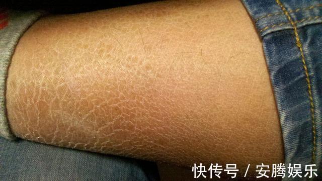 葡萄糖|身上有两处发痒,可能是糖尿病的信号,中老年人不要掉以轻心