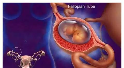 阴道出血|如果孕期发现这5种异常出血情况,立刻去医院!