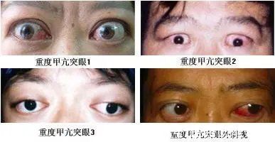 矿泉水瓶|加班、熬夜、生闷气…22岁女生眼肿成“金鱼”！严重可致盲