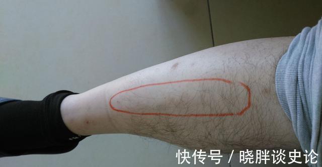 高血脂|高血脂患者，身体会有哪些表现，早了解早好