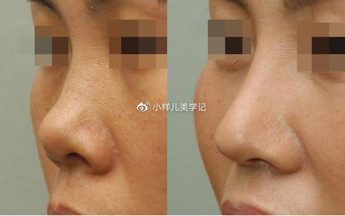 朝天鼻修复手术会出现哪些后遗症，影响因素呢？