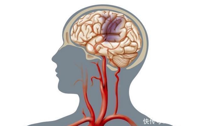 提醒脑梗病人,饭后“最忌”2件事,易脑梗供血不足,脑梗病发